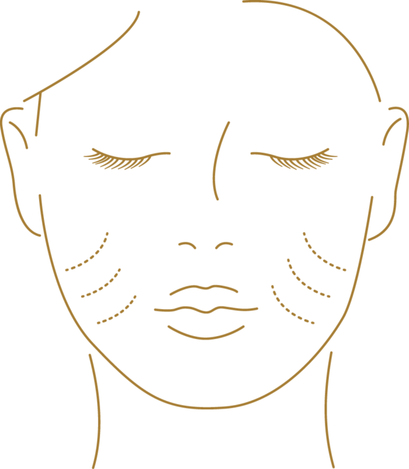 Grafik Facelift, Plastische Chirurgie Bern, Dr. Kiermeir