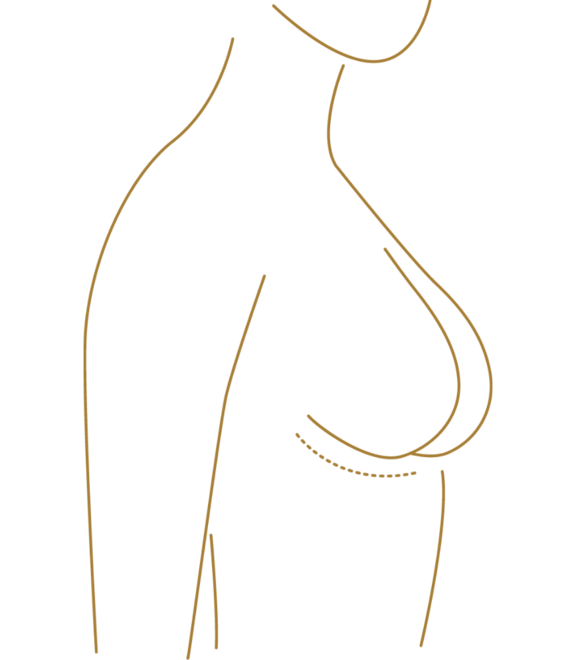 Grafik Brustvergrösserung, Plastische Chirurgie Bern, Dr. Kiermeir